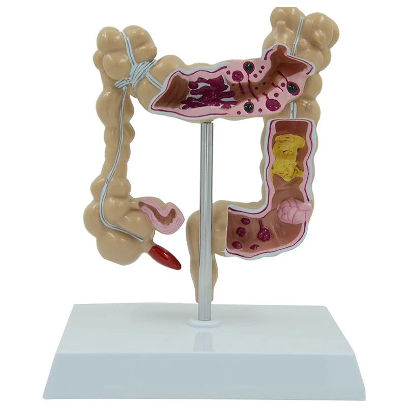 Модель анатомии колоректального поражения Модель патологических заболеваний толстой кишки человека Медицинский органайзер Оборудование Инструмент